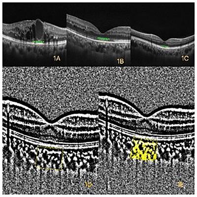 Quantitative assessment of OCT and OCTA parameters in diabetic retinopathy with and without macular edema: single-center cross-sectional analysis